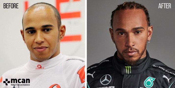 How Lewis Hamilton Overcame Baldness: A Closer Look at His Hair Journey