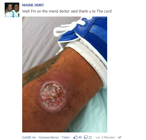 UFC Fighter Mark Hunt Struggles with Staph Infection After Loss to JDS
