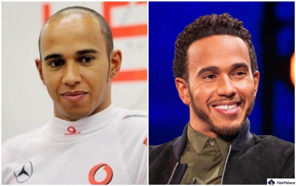 Lewis Hamilton Hairline: The Truth Behind His Stunning Transformation