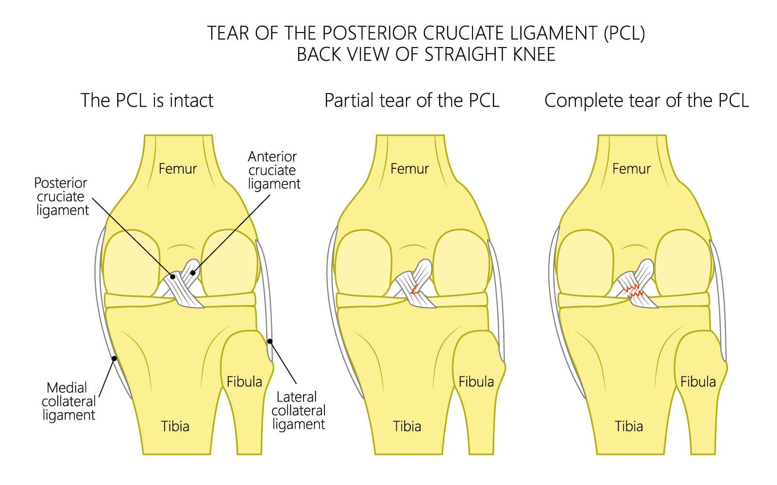 Can you play football with a torn ACL? Advice from players.